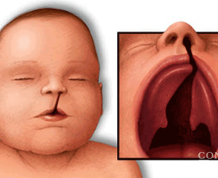 How to Prevent Cleft Lip and Palate During Pregnancy?