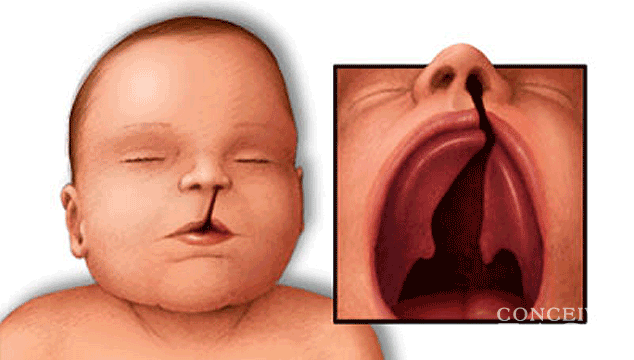 How to Prevent Cleft Lip and Palate During Pregnancy?