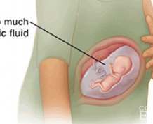 Induced Labor Due to Polyhydramnios