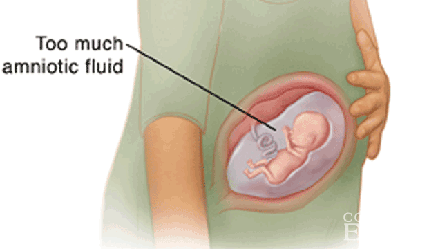 Induced Labor Due to Polyhydramnios