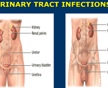 Is Hemorrhoids Related to Urinary Tract Infection?