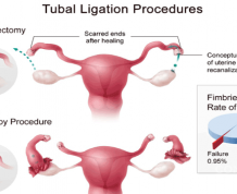 Can I Get Pregnant with Bilateral Tubal Ligation?