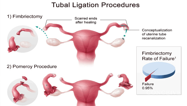 Can I Get Pregnant with Bilateral Tubal Ligation?