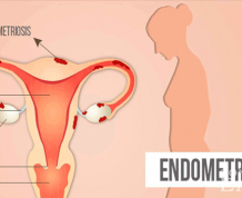 Can I get Pregnant with Fibroids and Endometriosis?