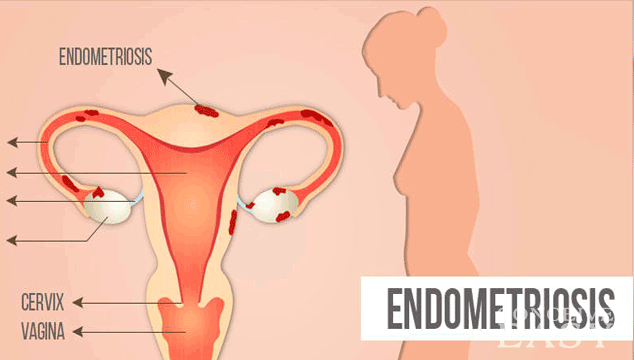 Can I get Pregnant with Fibroids and Endometriosis?