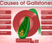 Can I get Pregnant with Gallstones?