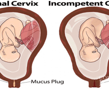 Incompetent Cervix and Gestational Diabetes