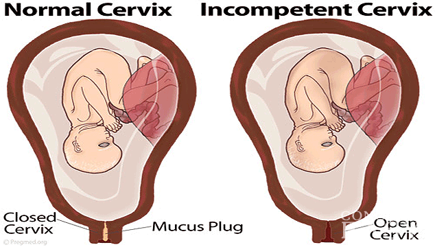 Incompetent Cervix and Gestational Diabetes