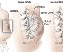 Neural Tube Defect: Spina Bifida