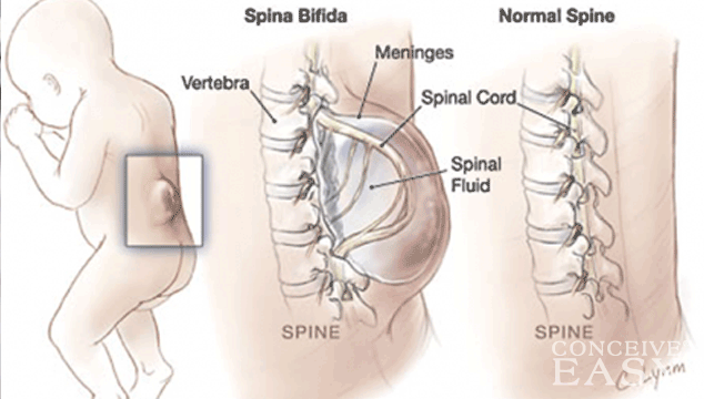 Neural Tube Defect: Spina Bifida