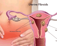 Can I get Pregnant with Intramural Fibroids?