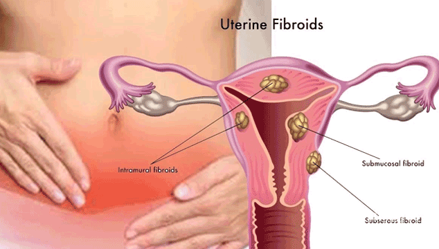 Can I get Pregnant with Intramural Fibroids?