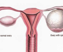 Can I get Pregnant with Ovary Cyst?