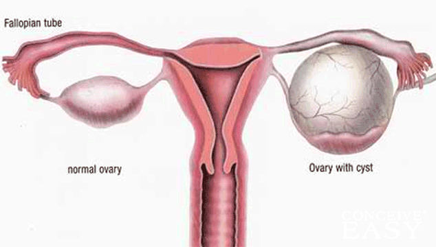 Can I get Pregnant with Ovary Cyst?