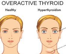 Can I get Pregnant with Overactive Thyroid?