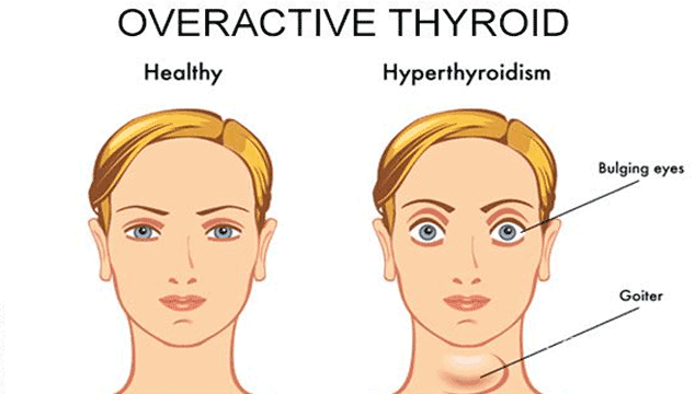 Can I get Pregnant with Overactive Thyroid?