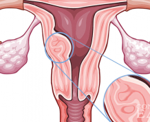 Can I get Pregnant with Submucosal Fibroid?