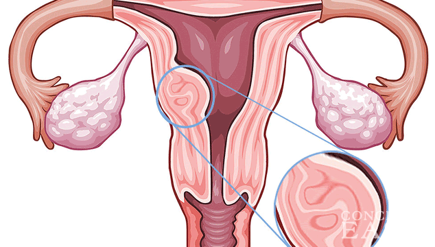 Can I get Pregnant with Submucosal Fibroid?