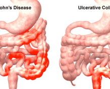 Can I get Pregnant with Ulcerative Colitis?