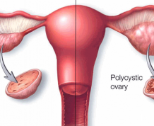 A New Name Sought For PCOS?