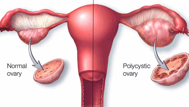 A New Name Sought For PCOS?