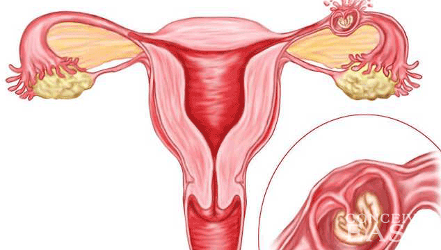 Pregnancy: Ectopic/Tubal Pregnancy and Miscarriage