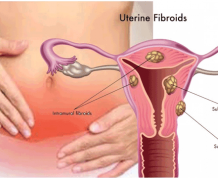 Getting Pregnant If You Have Fibroids