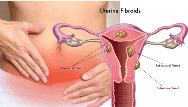 Getting Pregnant If You Have Fibroids