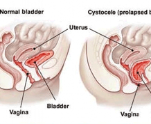 Getting Pregnant With A Prolapsed Uterus