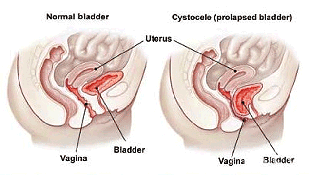 Getting Pregnant With A Prolapsed Uterus