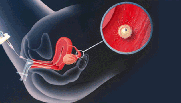 intrauterine insemination (IUI) to help get pregnant