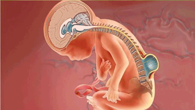 spina bifida and neural tube defects 