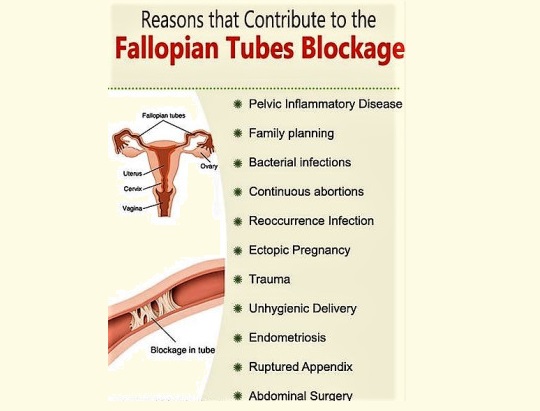 factors that contribute to block fallopian tubes