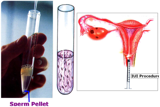 Intrauterine insemination (IUI) procedure and sperm washing