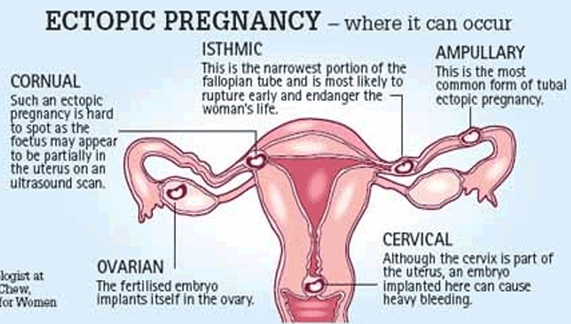 different types of ectopic pregnancy