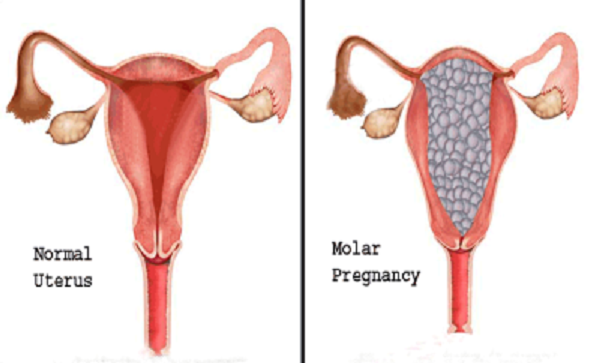 does molar pregnancy cause bleeding?