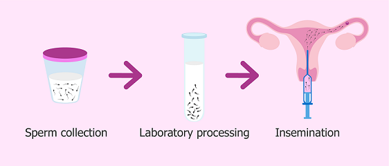 Intrauterine insemination process and procedure