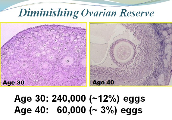 diminished ovarian reserve after age 40