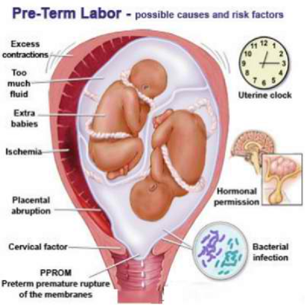 Risks and Causes of Pre-term labor