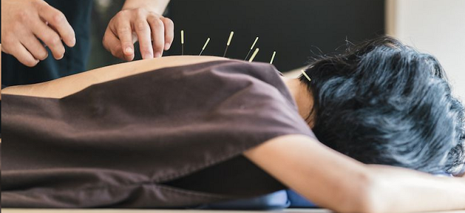 acupuncture - an alternative to fertility medicines