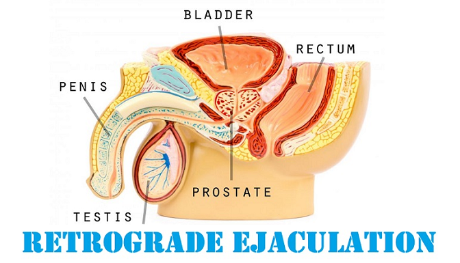 retrograde ejaculation