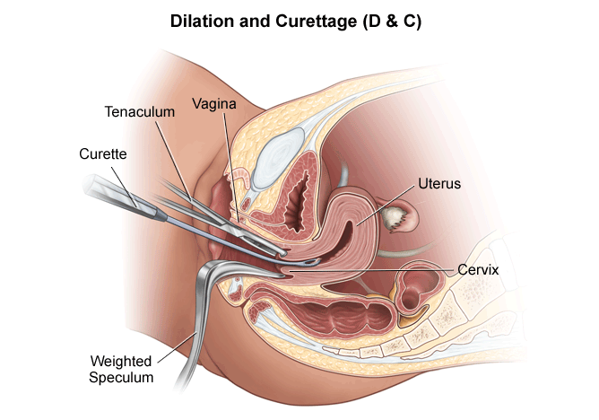 D & C Procedure