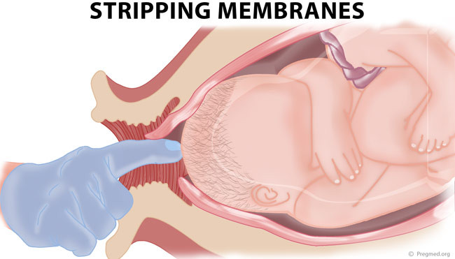 Membrane Stripping To Induce Labor