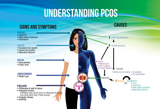 PCOS signs, symptoms and causes