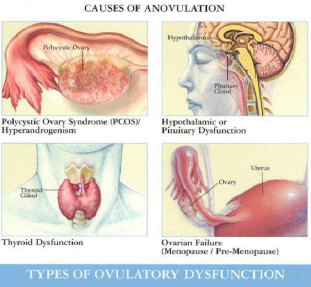 causes of anovulation