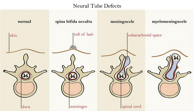 neural tube defects