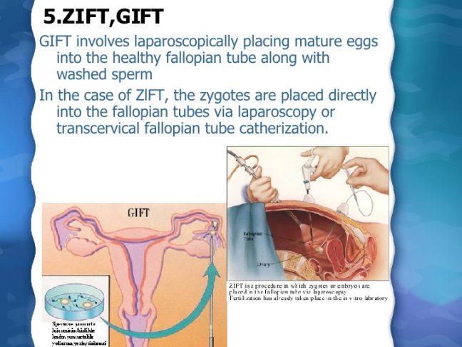 GIFT and ZIFT