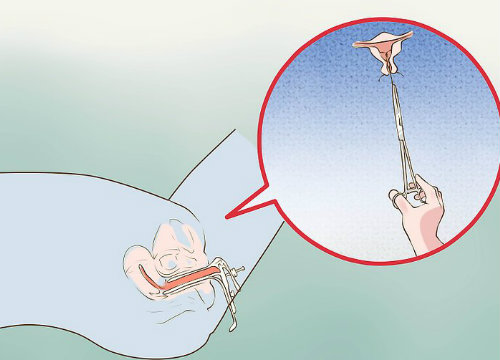 IUD removal