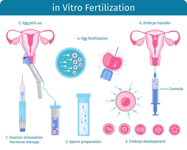 in vitro fertilization