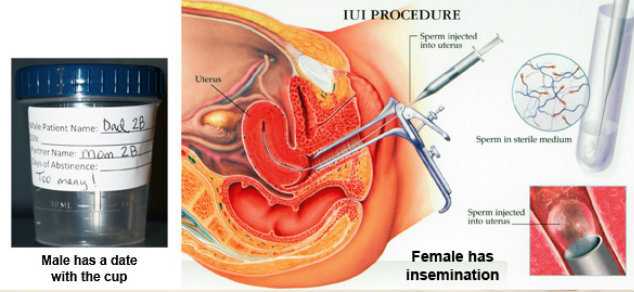 Intrauterine Insemination